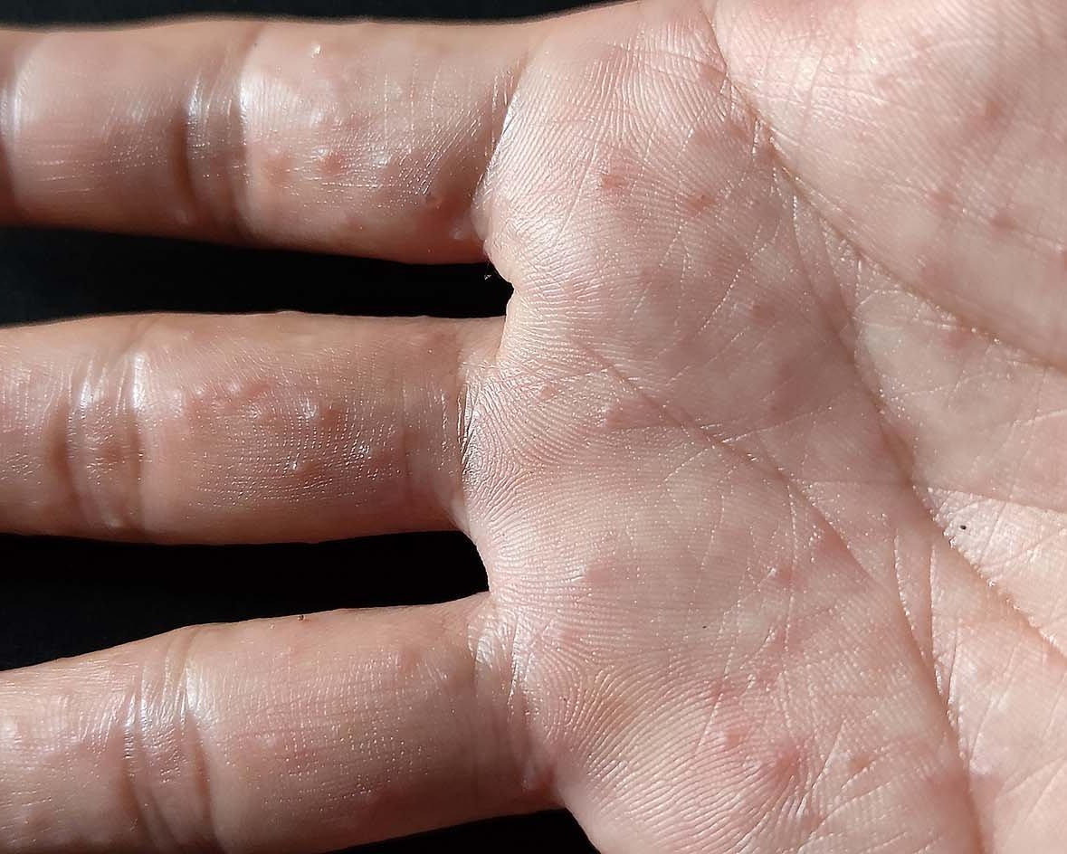 Dyshidrosis on finger